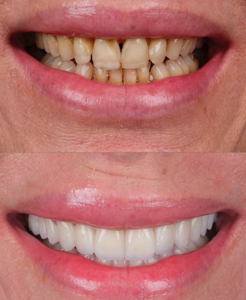 faccette dentali milano