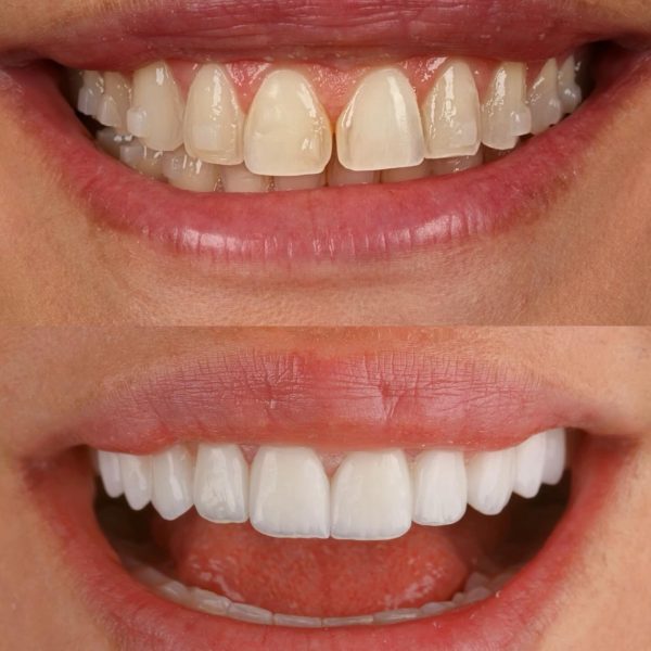 faccette dentali milano