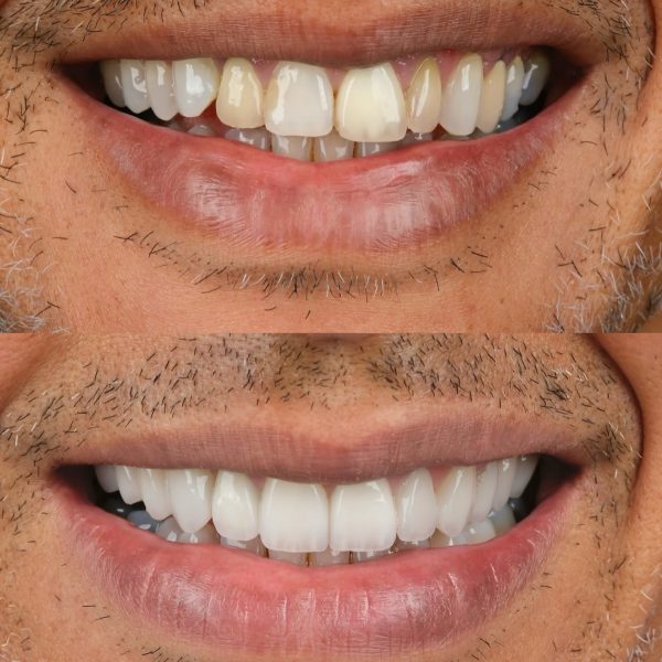 faccette dentali milano