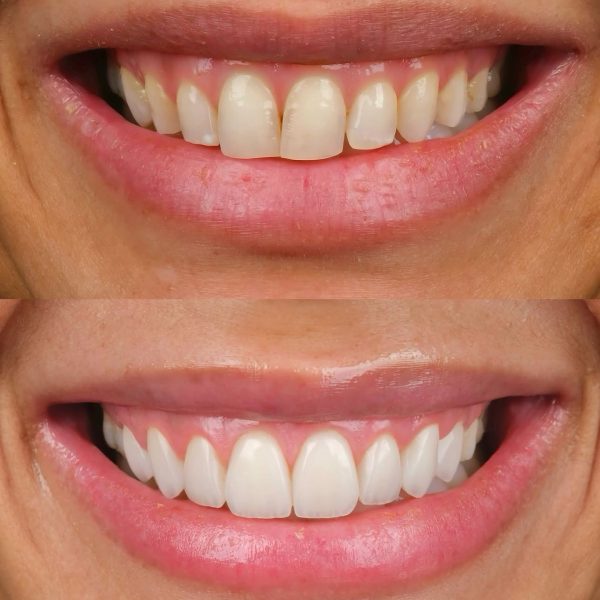faccette dentali milano