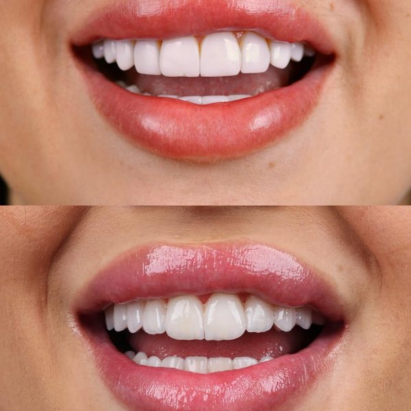 faccette dentali milano