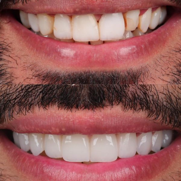 faccette dentali milano