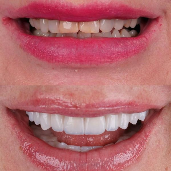 faccette dentali milano