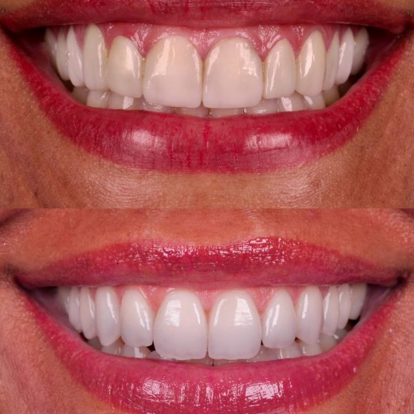 faccette dentali milano