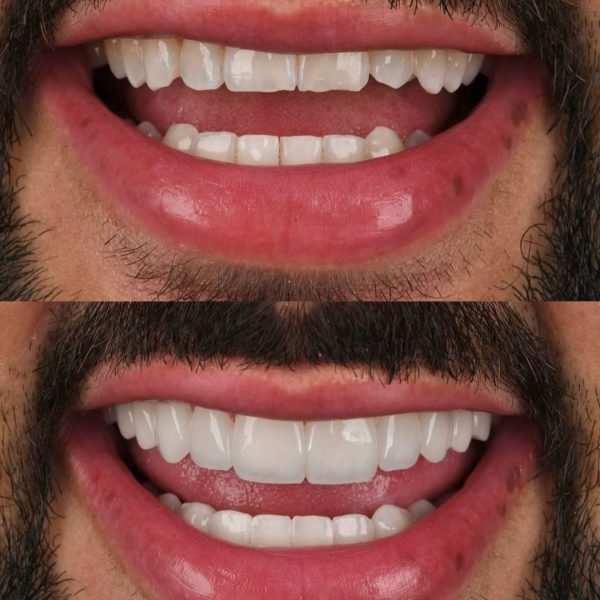 faccette dentali milano