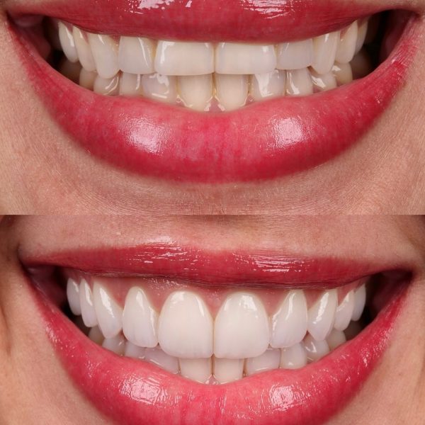 faccette dentali milano