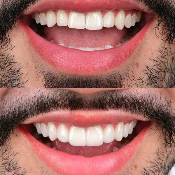 faccette dentali milano