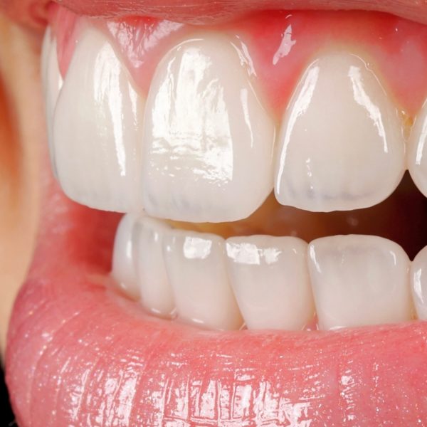 faccette dentali milano