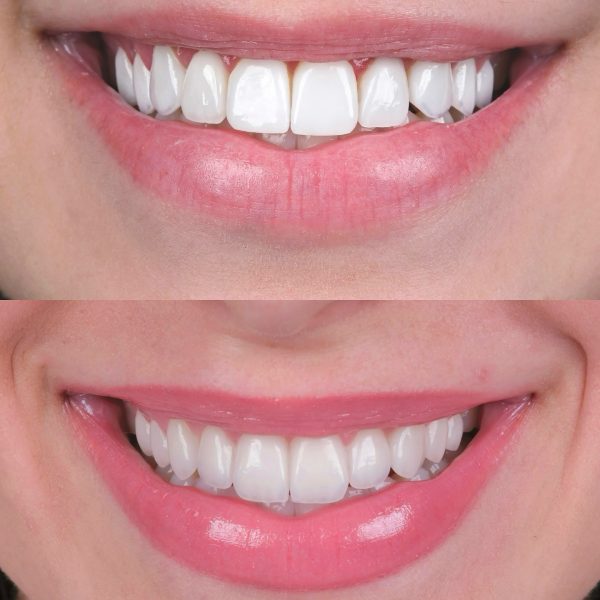 faccette dentali milano