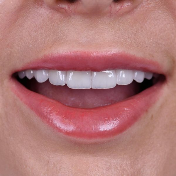 faccette dentali milano