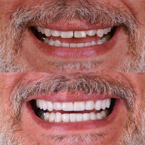 faccette dentali milano