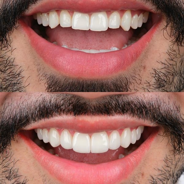 faccette dentali milano