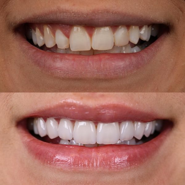 faccette dentali milano