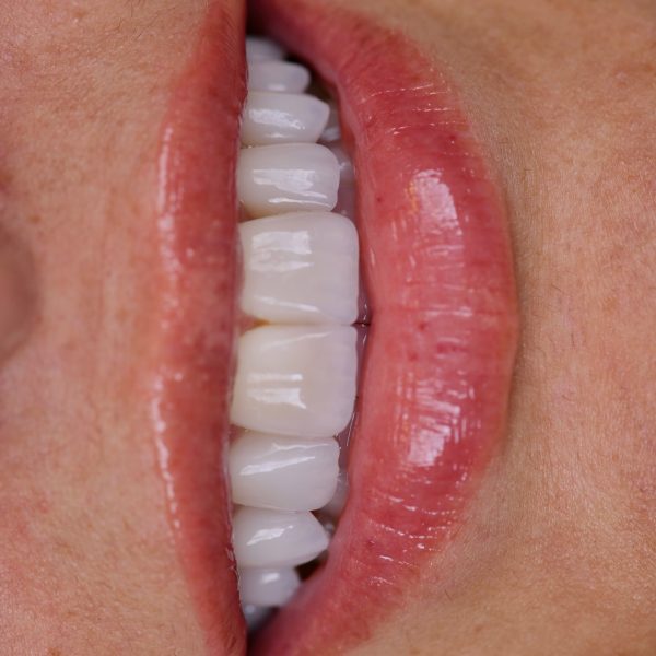 faccette dentali milano