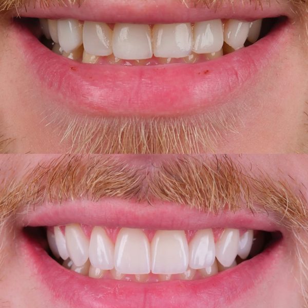 faccette dentali milano