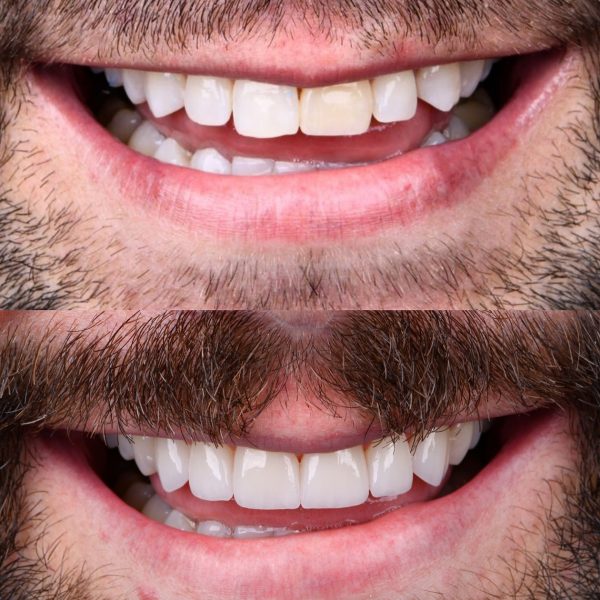 faccette dentali milano