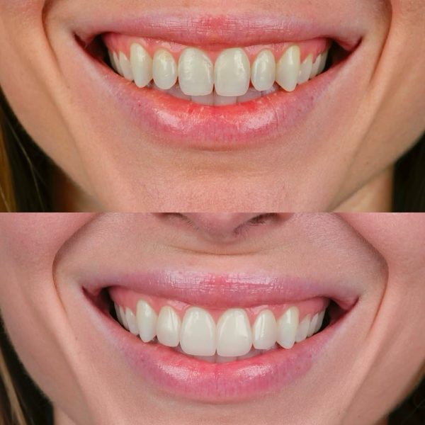 faccette dentali milano