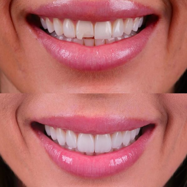 faccette dentali milano