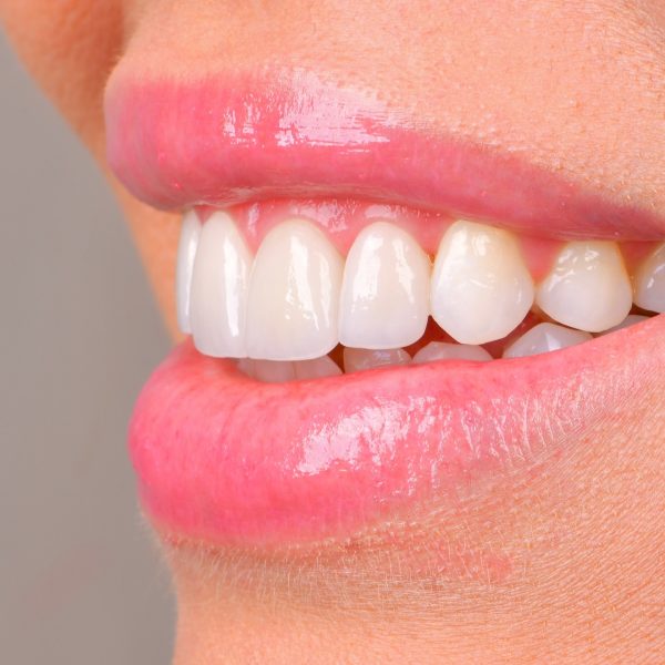 faccette dentali milano