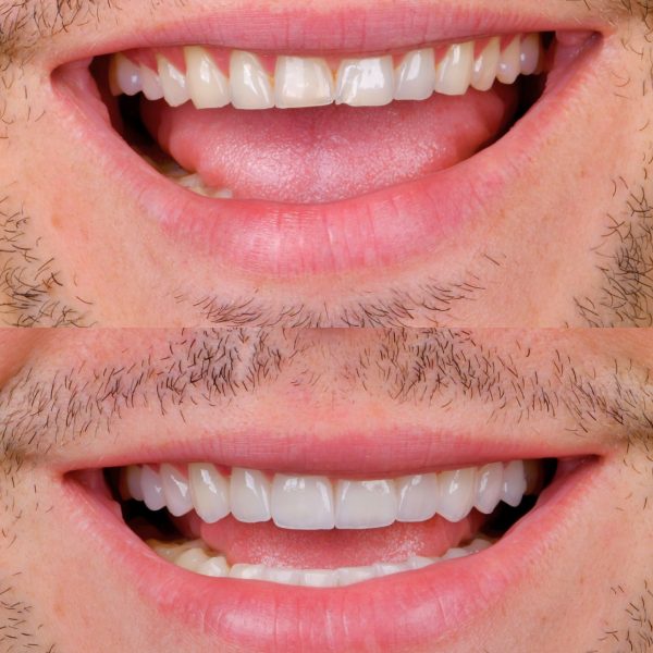 faccette dentali milano