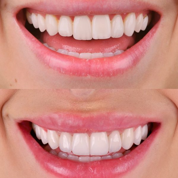 faccette dentali milano