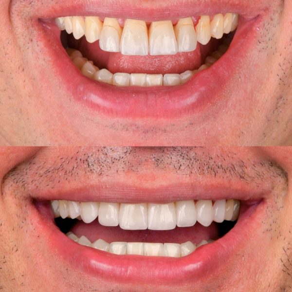 faccette dentali milano