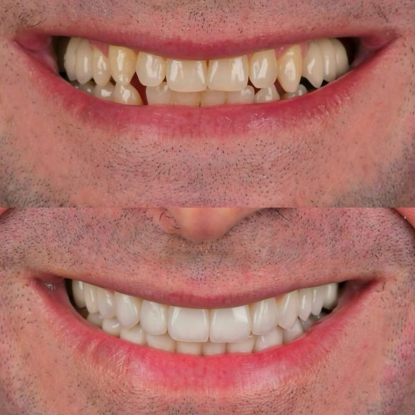 faccette dentali milano