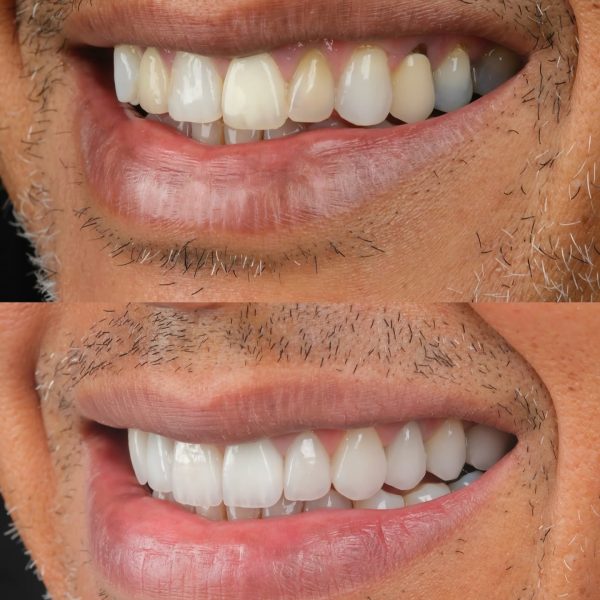 faccette dentali milano