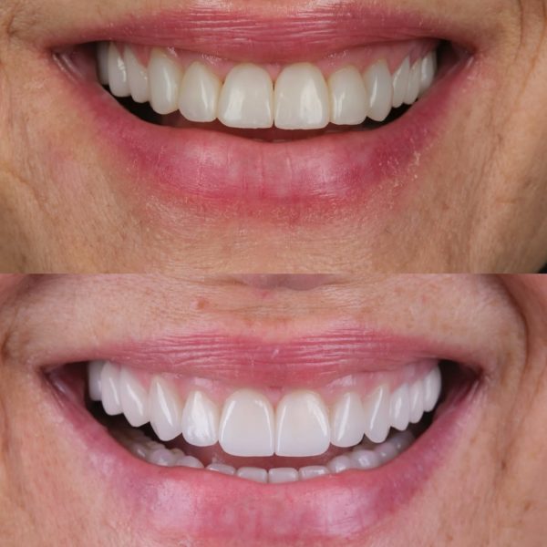 faccette dentali milano