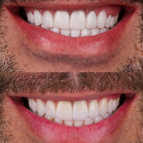 faccette dentali milano