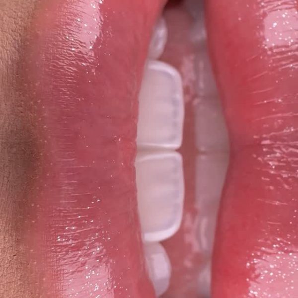 faccette dentali milano