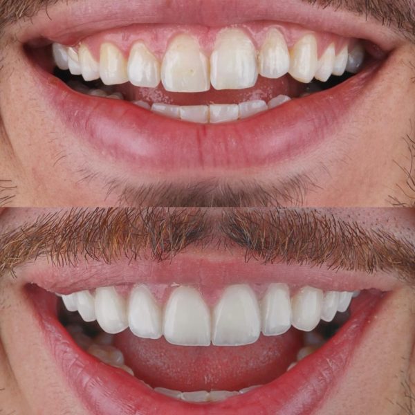 faccette dentali milano