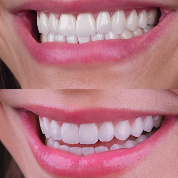 faccette dentali milano