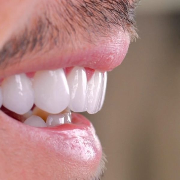 faccette dentali milano