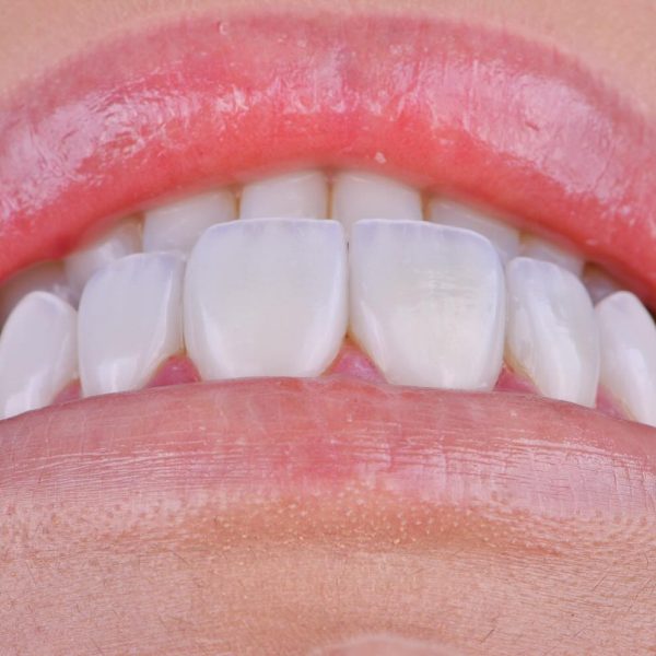 faccette dentali milano