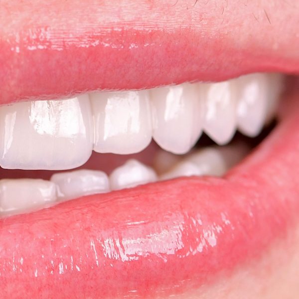 faccette dentali milano