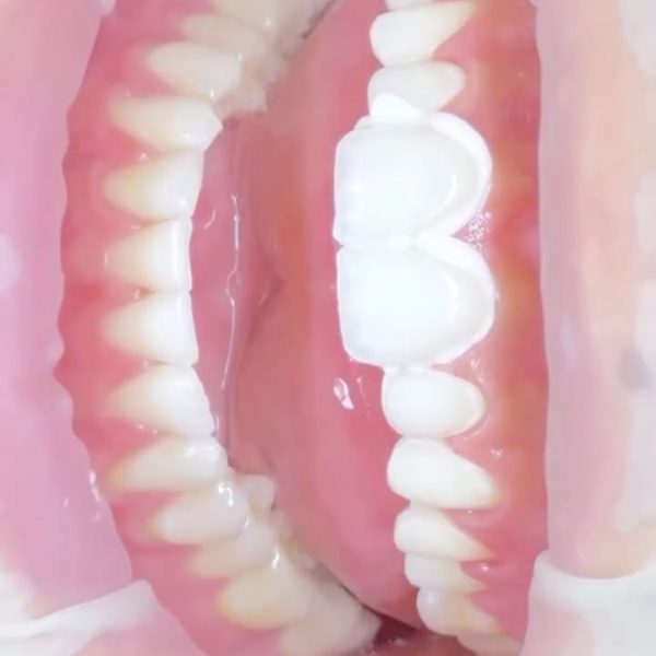 faccette dentali milano