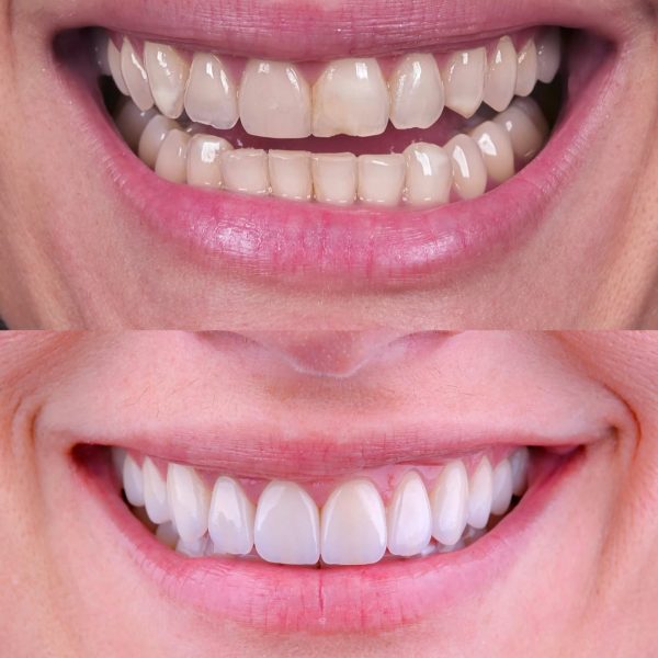 faccette dentali milano