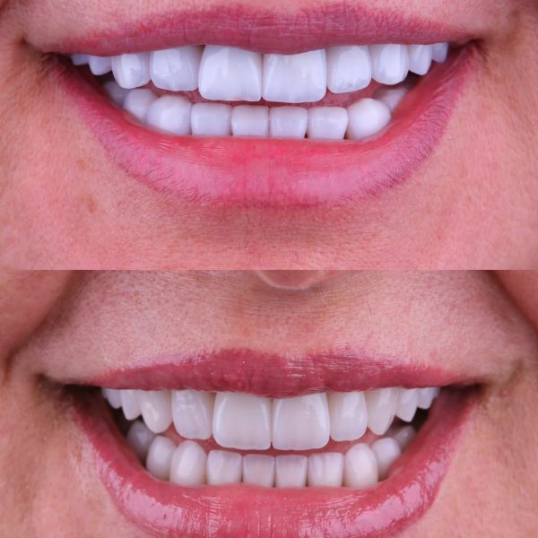 faccette dentali milano