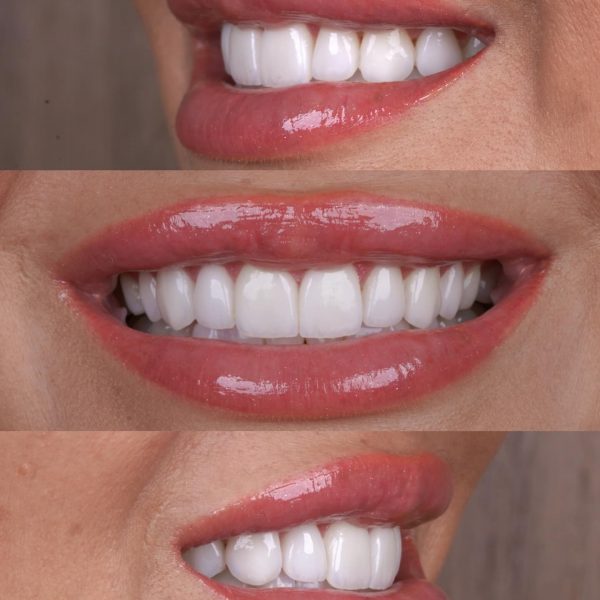 faccette dentali milano