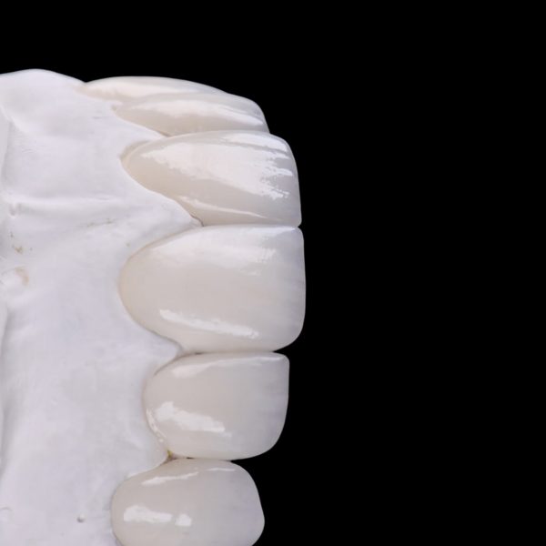 faccette dentali milano