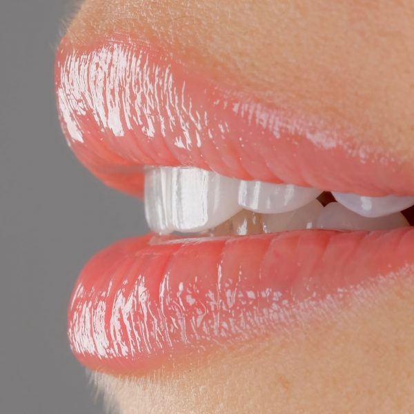 faccette dentali milano