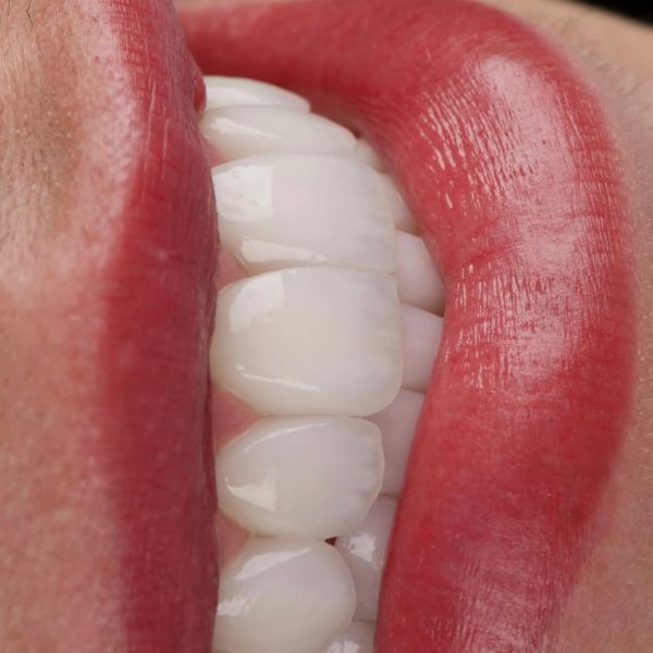 faccette dentali milano