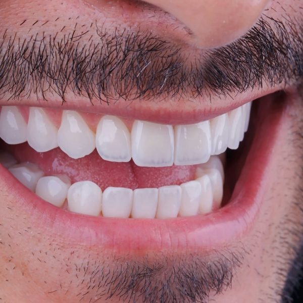 faccette dentali milano